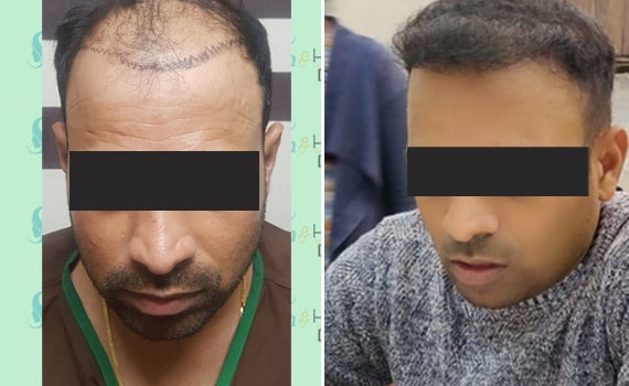 Before & After Hair Transplantation - Patient 1