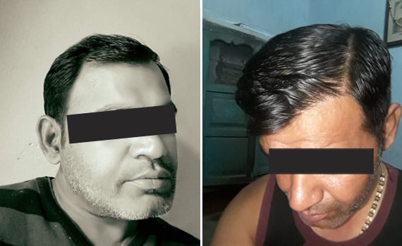Before & After Hair Transplantation - Patient 12
