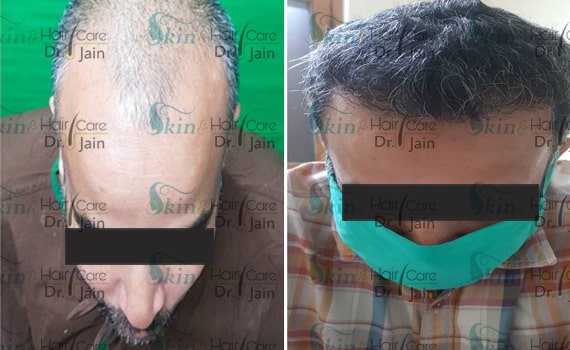 Before & After Hair Transplantation - Patient 14