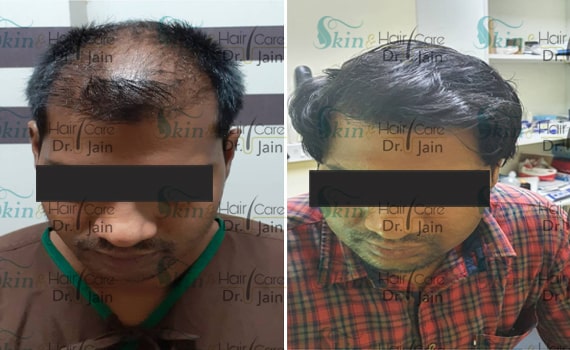 Before & After Hair Transplantation - Patient 17