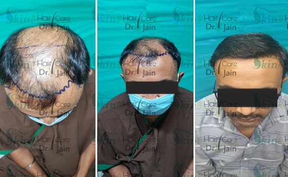 Before & After Hair Transplantation - Patient 18