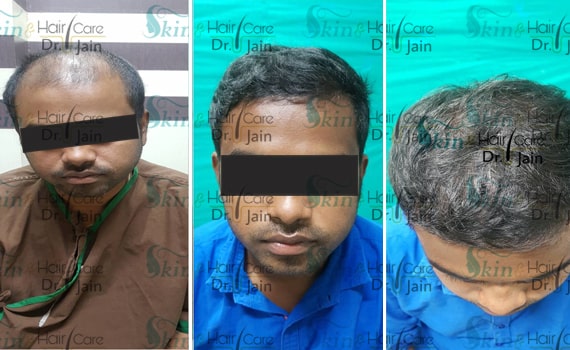 Before & After Hair Transplantation - Patient 20