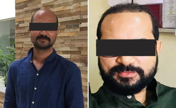 Before & After Hair Transplantation - Patient 7
