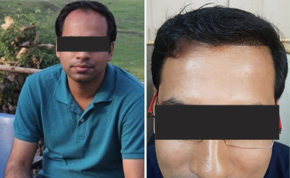 Before & After Hair Transplantation - Patient 8