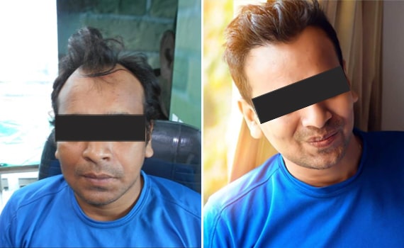 Before & After Hair Transplantation - Patient 9